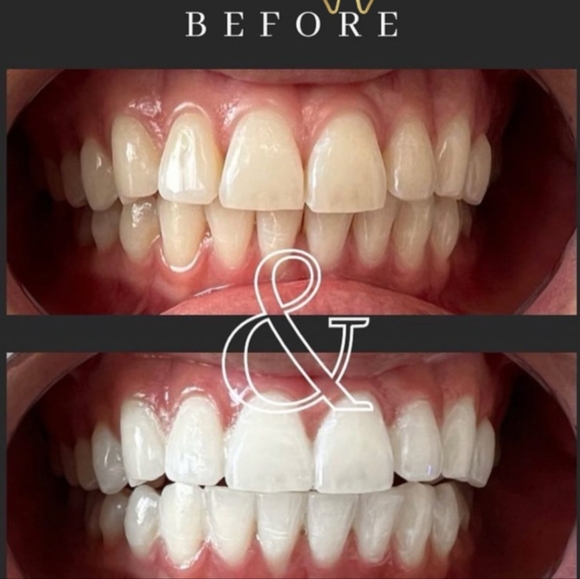 Teeth Whitening Pens. (2) 16% HP. Up to 8 Shades Whiter after the first use. - Picture 2 of 4